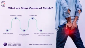 causes of fistula