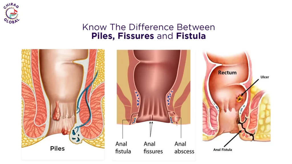 difference between piles and fissure and fistula